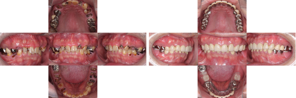 全顎保険治療 実例1