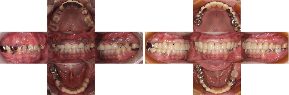 全顎保険治療 実例2