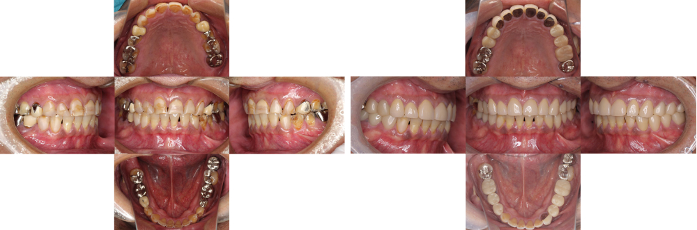 全顎保険治療 実例3