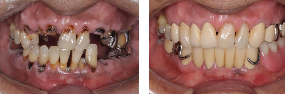 全顎保険治療 実例4