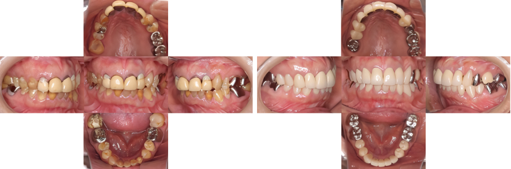 全顎保険治療 実例5