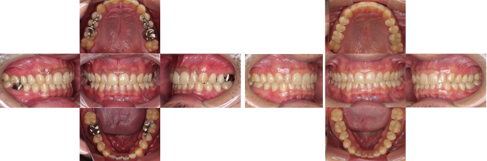 全顎保険治療 実例6