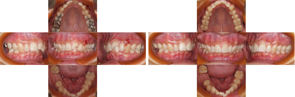 全顎保険治療 実例7