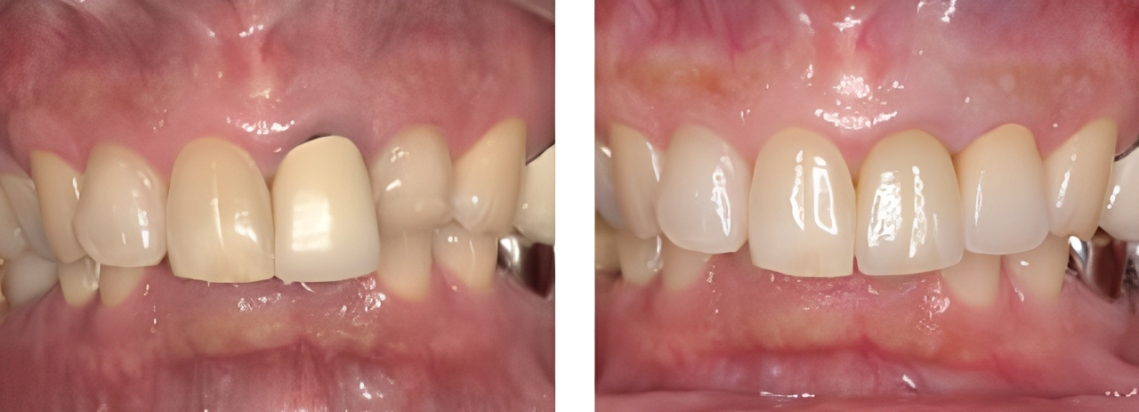 審美歯科 実例1