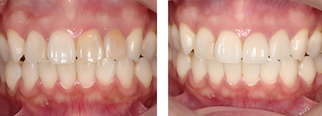 審美歯科 実例2