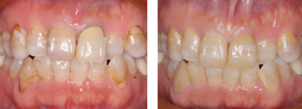 審美歯科 実例3