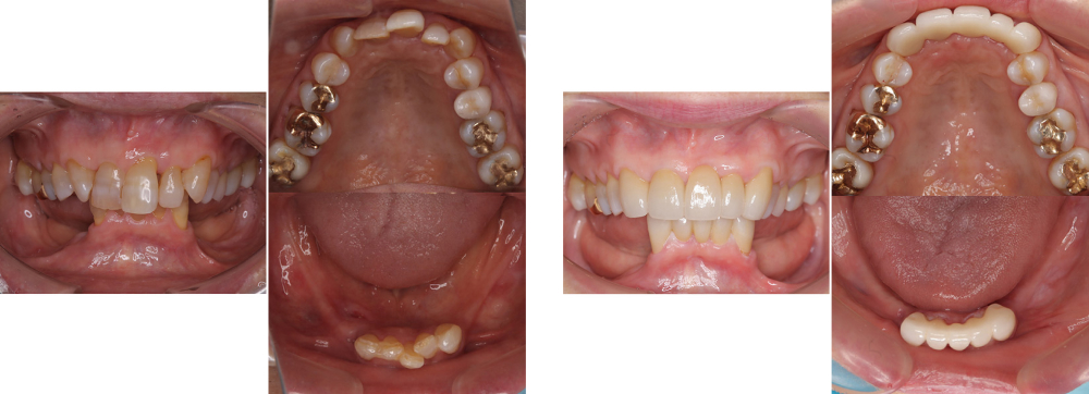 審美歯科 実例4