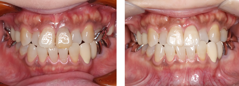 審美歯科 実例5
