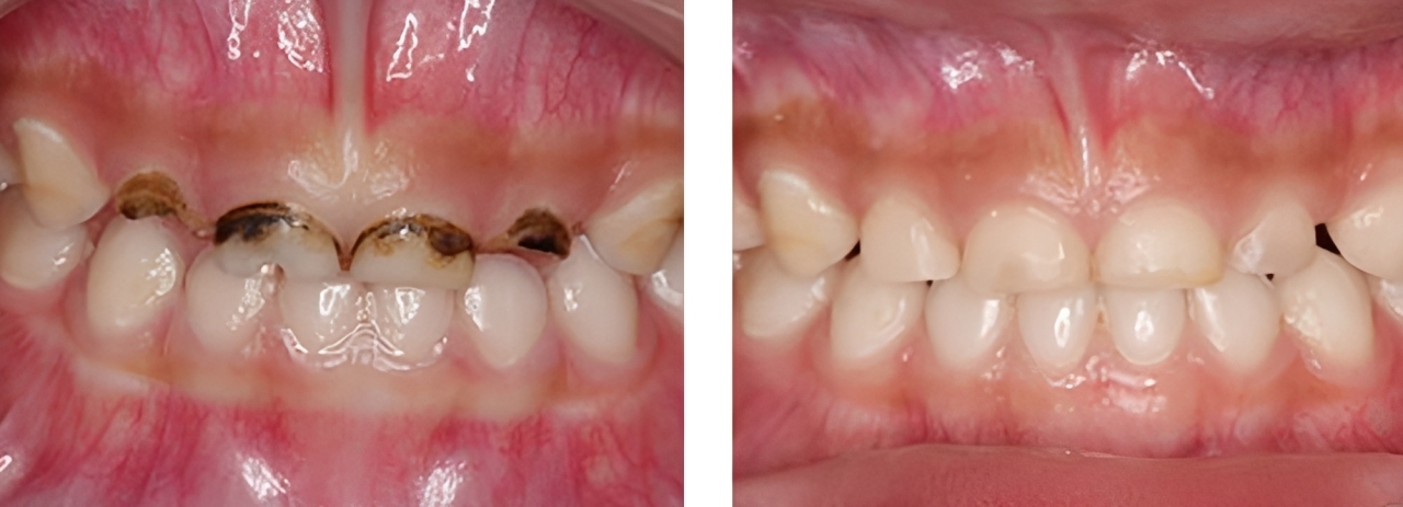 小児歯科 実例2