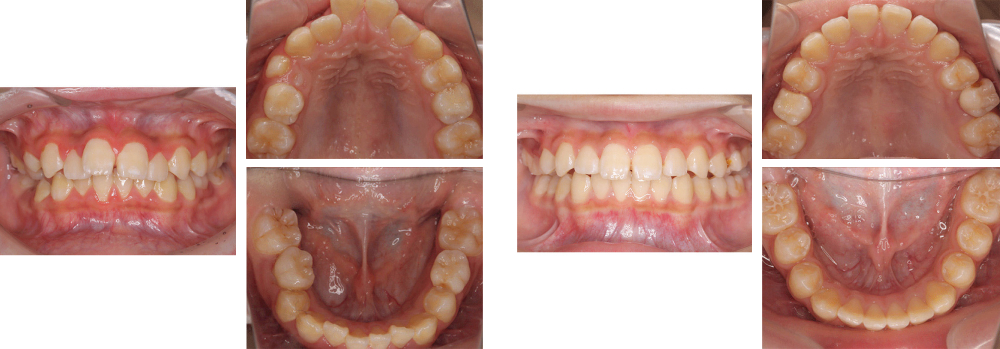 小児矯正 実例1
