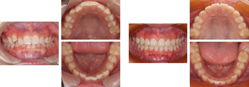 小児矯正 実例2