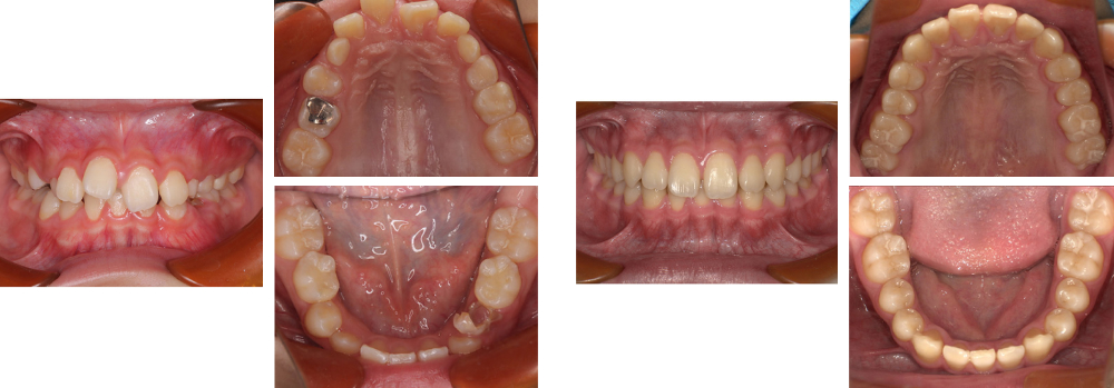 小児矯正 実例3