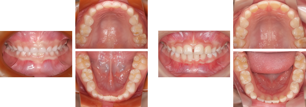 小児矯正 実例4