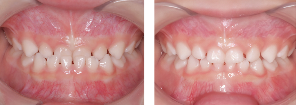 小児矯正 実例5