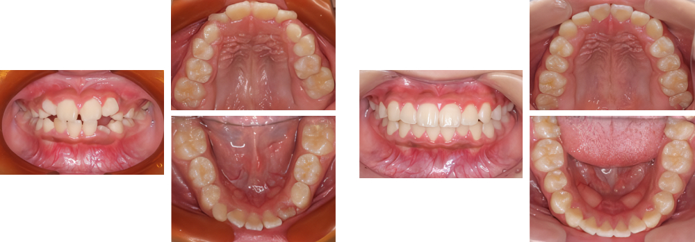 小児矯正 実例6