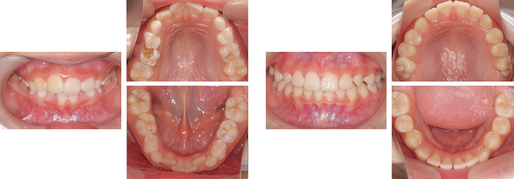 小児矯正 実例7