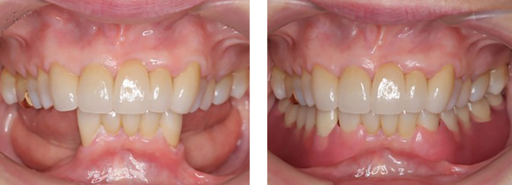 入れ歯治療 実例1