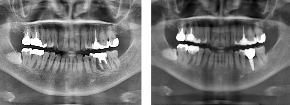 インプラント 実例1