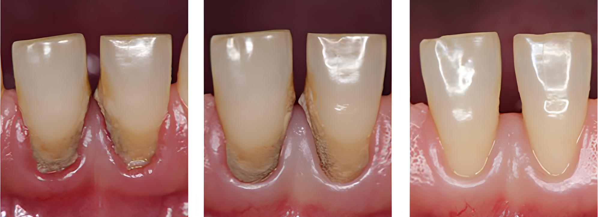 歯周病治療 実例1