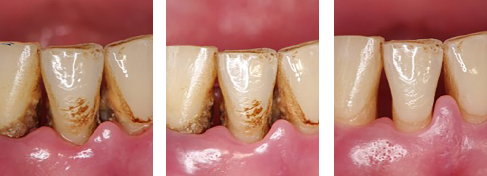 歯周病治療 実例1
