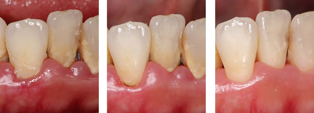 歯周病治療 実例1