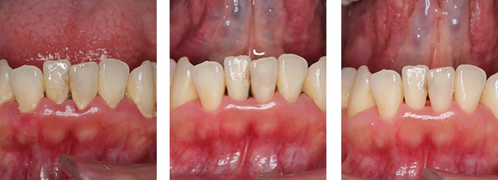 歯周病治療 実例1