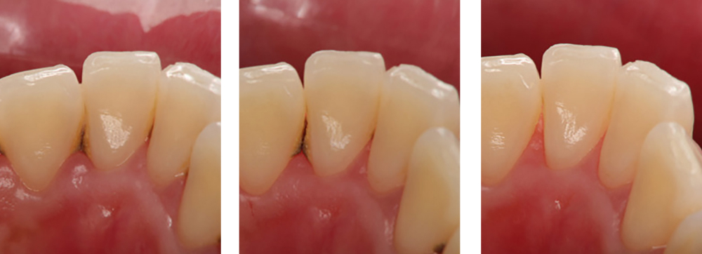 歯周病治療 実例1