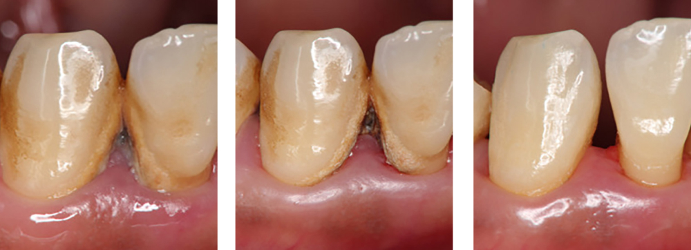 歯周病治療 実例1