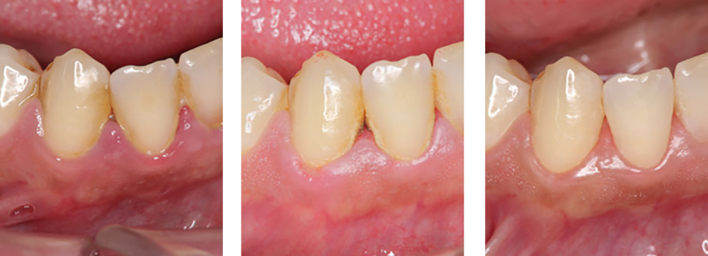 歯周病治療 実例1