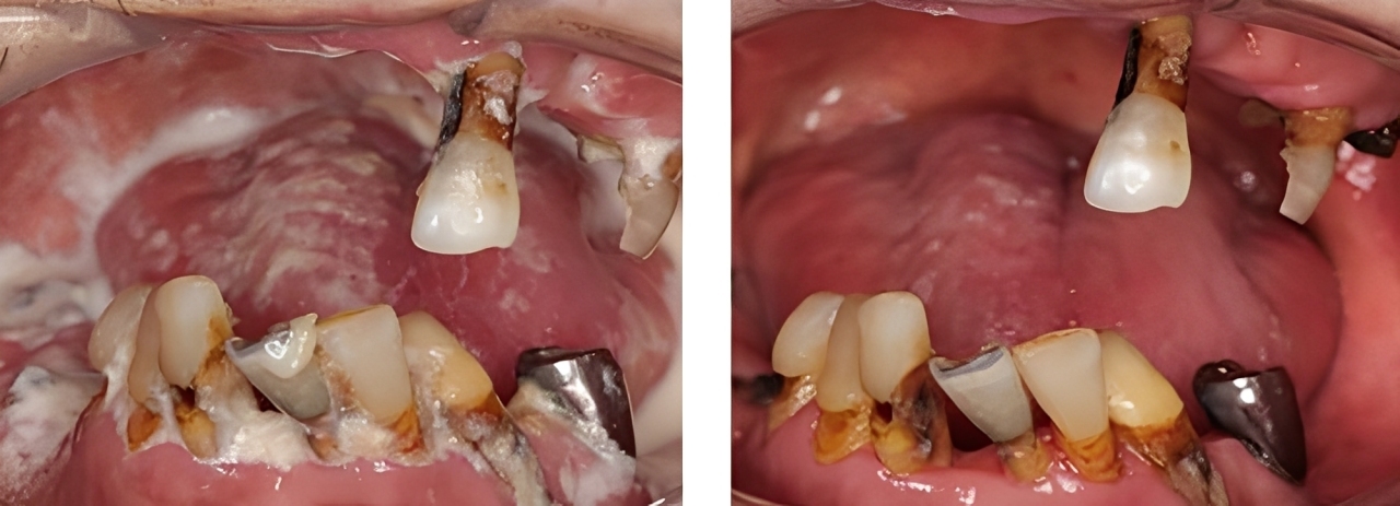 訪問歯科 実例1