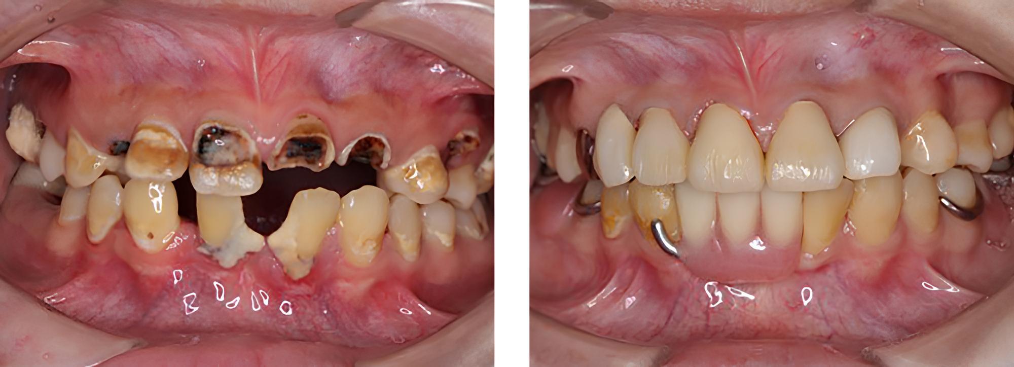 訪問歯科 実例2