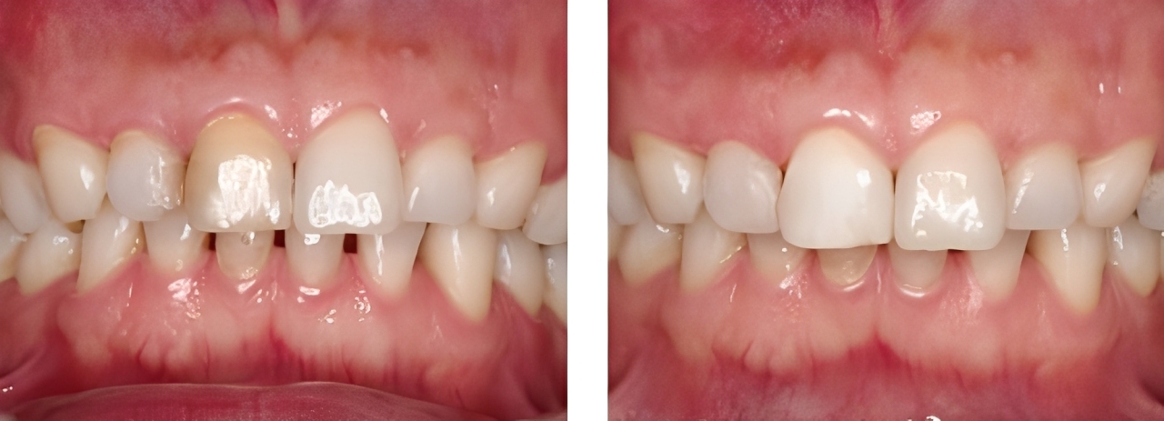 ホワイトニング 実例2
