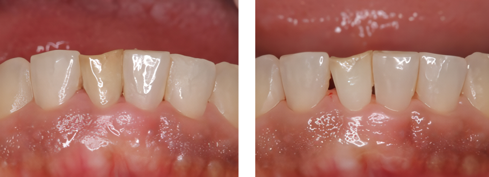 ホワイトニング 実例3