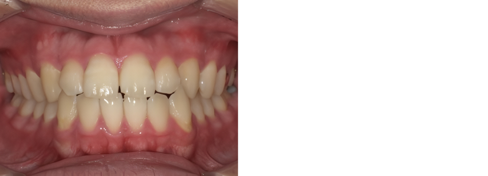 ホワイトニング 実例4