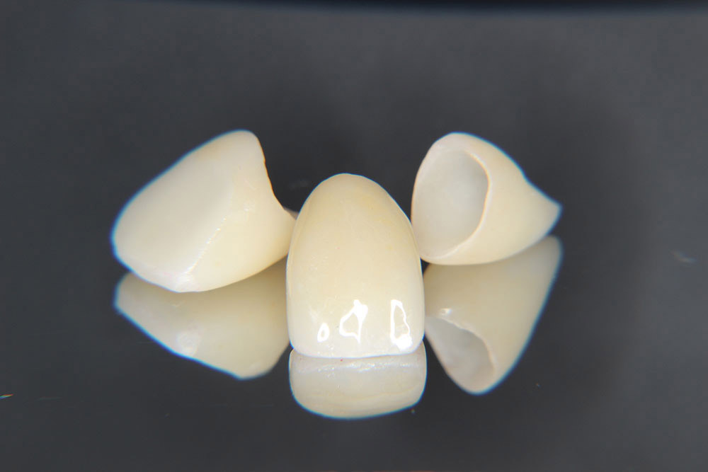 セラミック（インレー・クラウン）