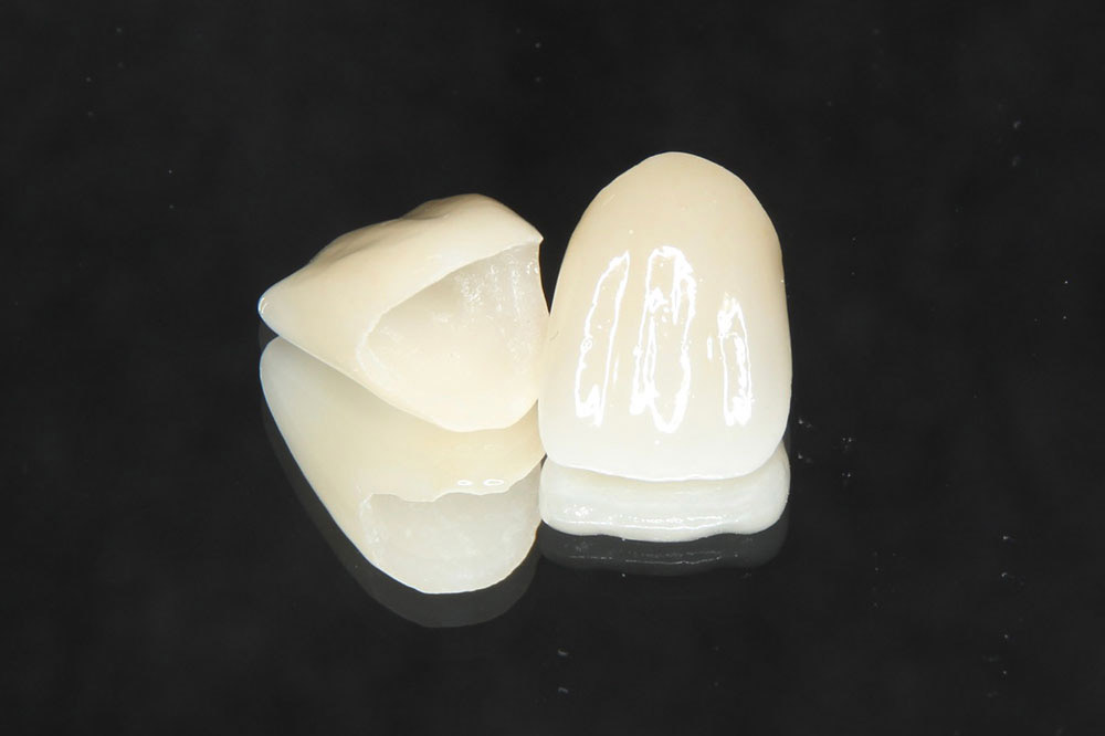 ハイブリット（インレー・クラウン）