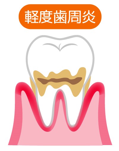 歯茎の腫れや出血がある