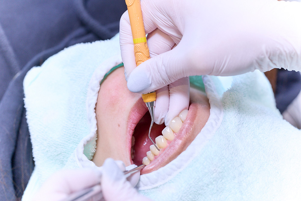 歯石除去（スケーリング）