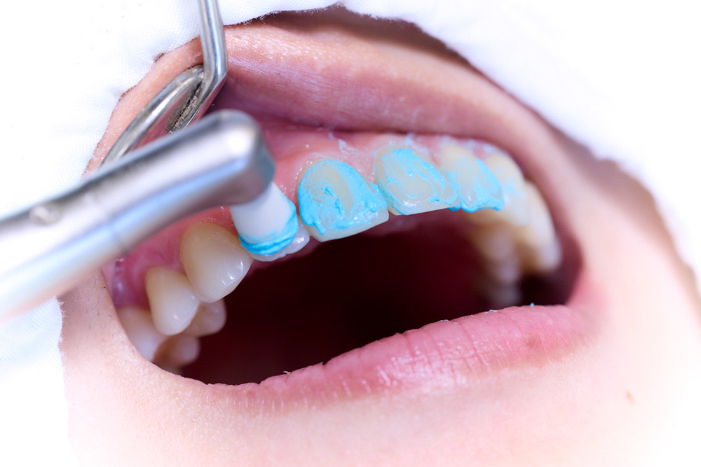 PMTC（クリーニング）